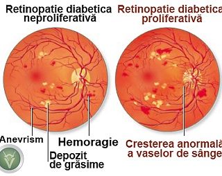 Retinopatia diabetică